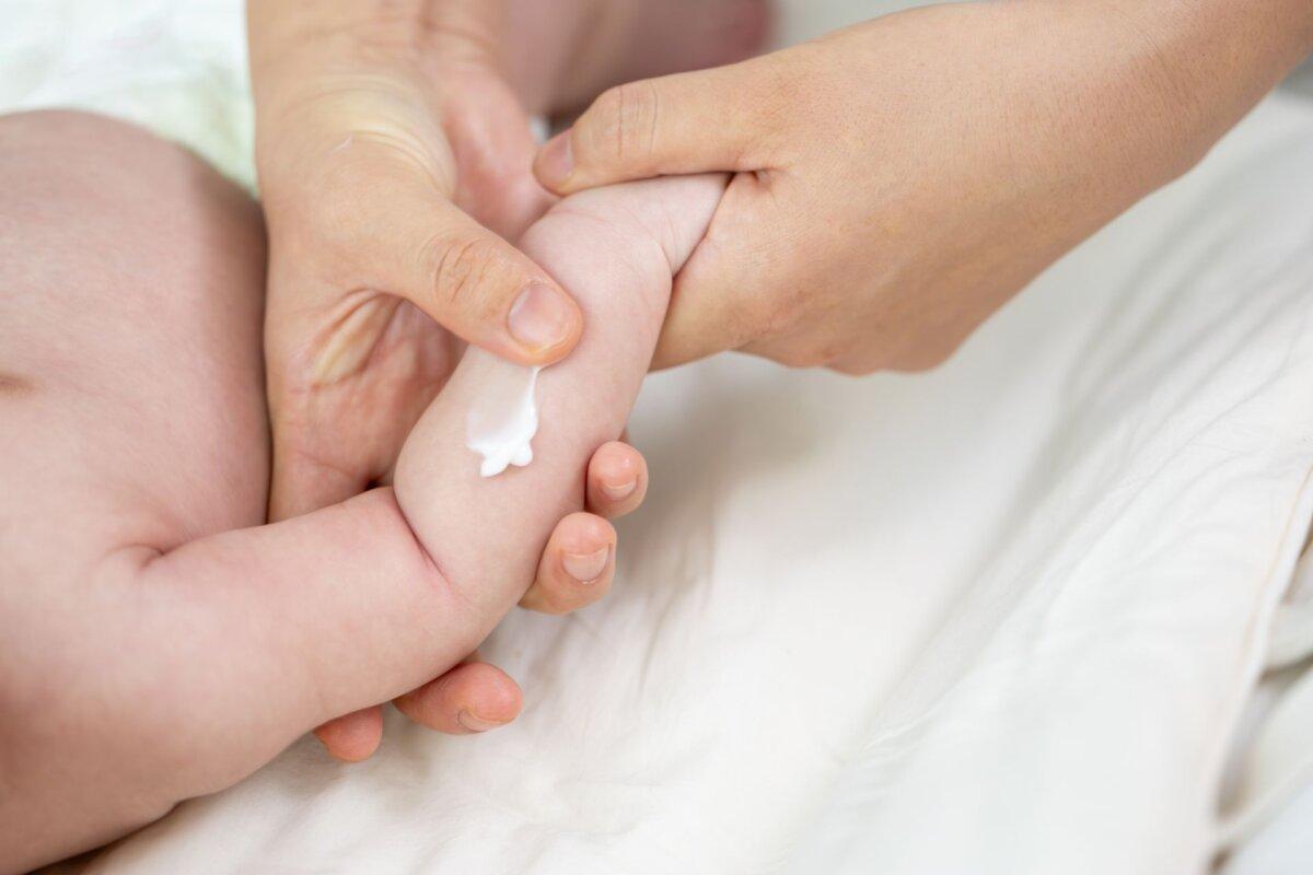 Bei Kindern mit atopischer Dermatitis sind topische Kortikosteroide unerlässlich.